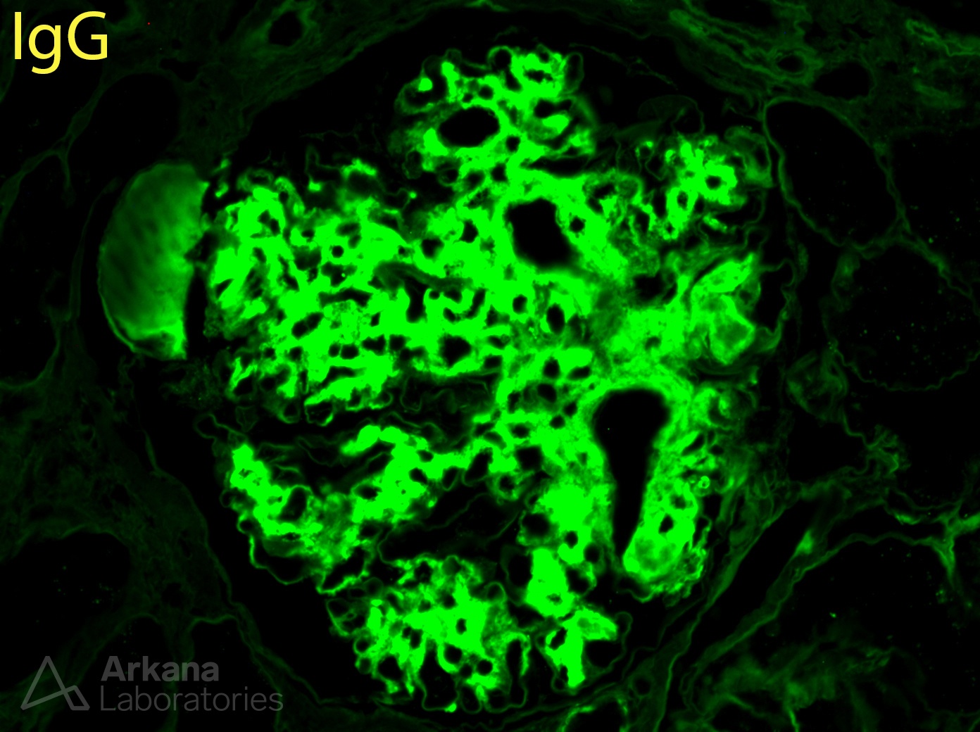 fibrillary glomerulopathy