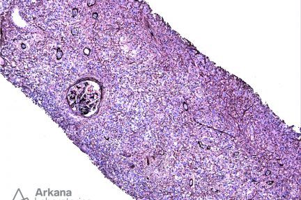 IgG4-Positive Plasma Cells