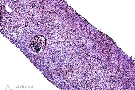 IgG4-Related Disease