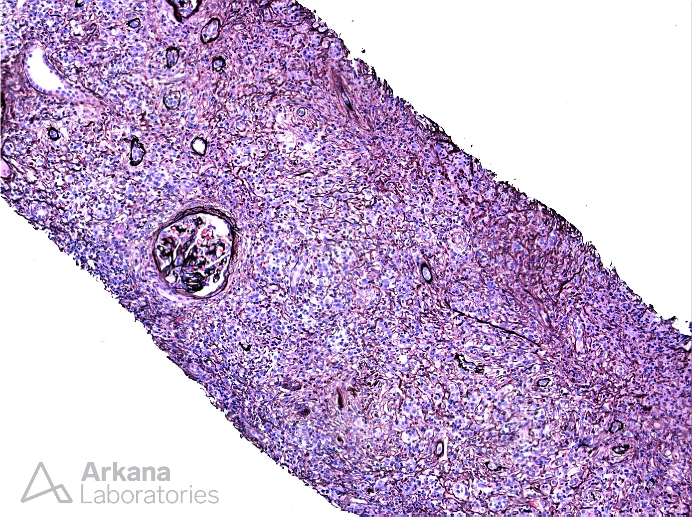 IgG4-Related Disease