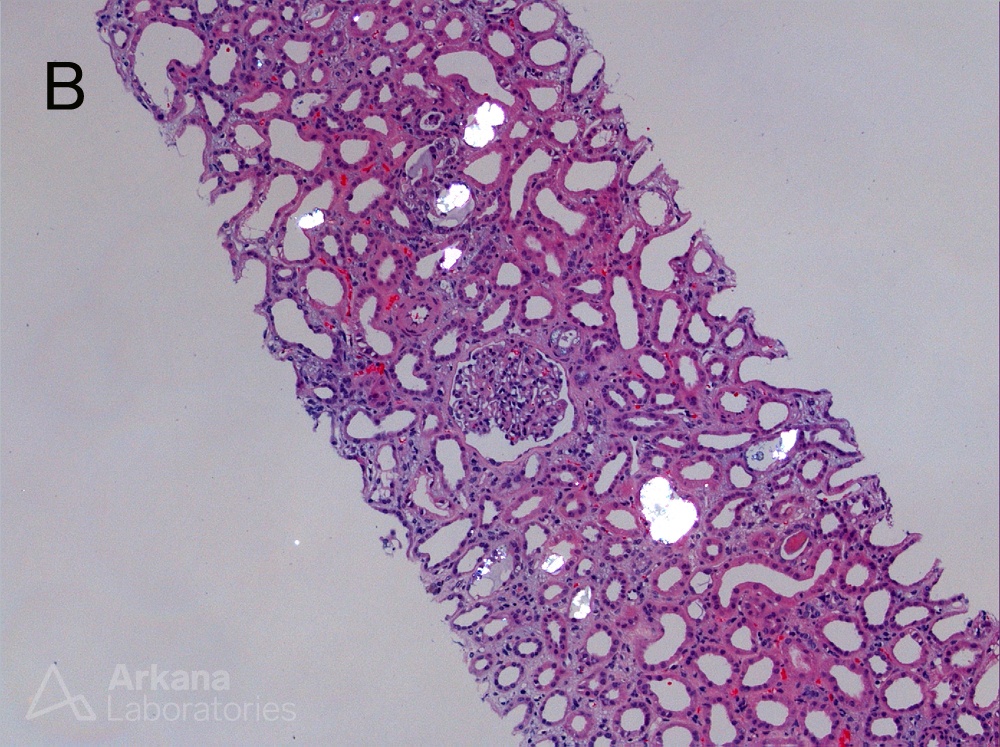 H&E stain, Oxalate Due to Vitamin C