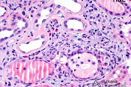 Eosinophil-Rich Inflammation in Diabetic Glomerulopathy