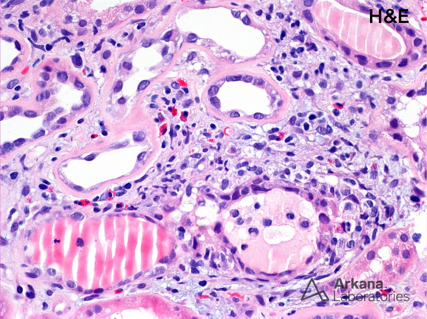 Eosinophil-Rich Inflammation in Diabetic Glomerulopathy