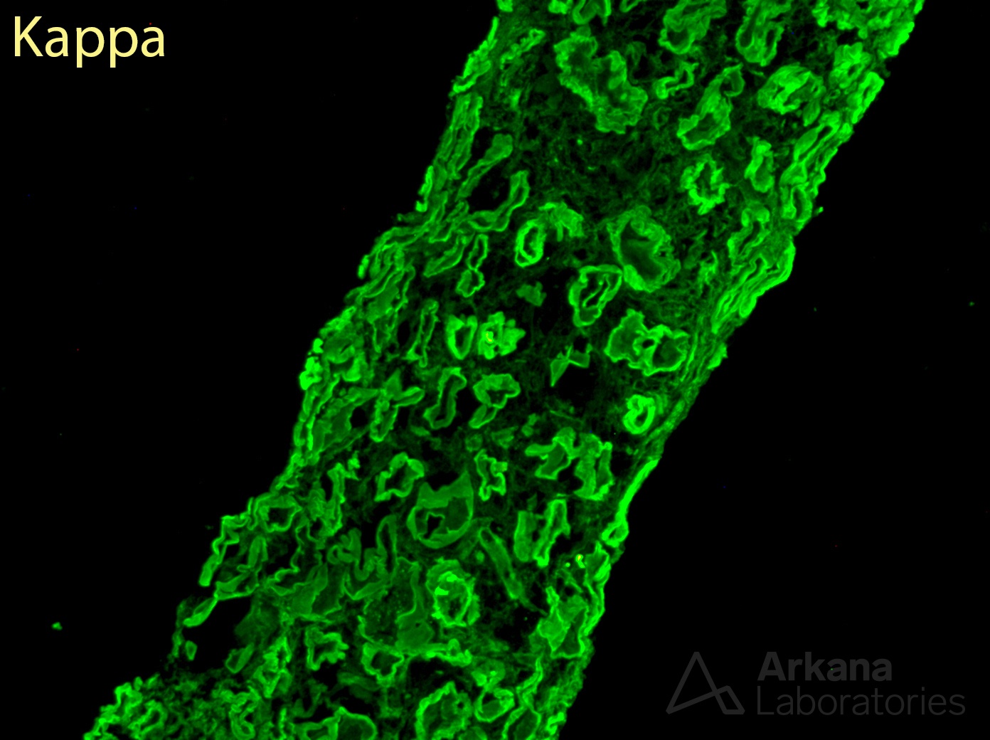 light chain deposition disease