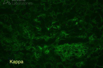 Light Chain Proximal Tubulopathy