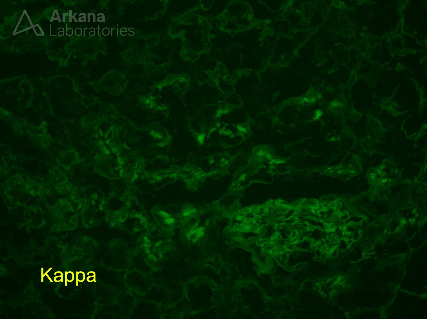 Light Chain Proximal Tubulopathy