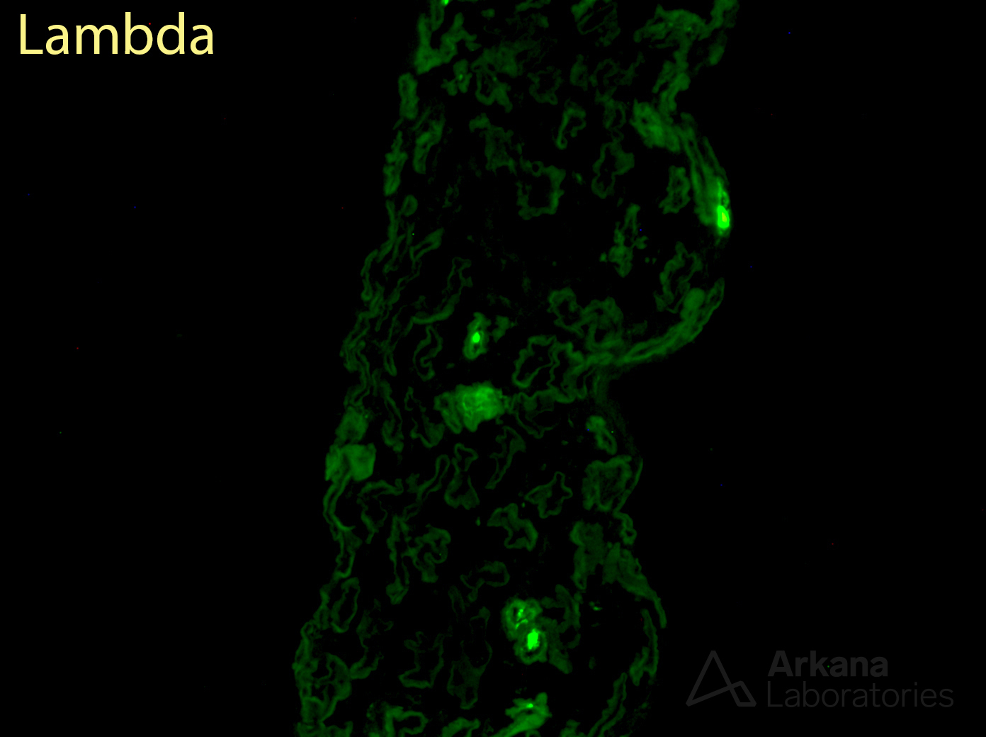 light chain deposition disease