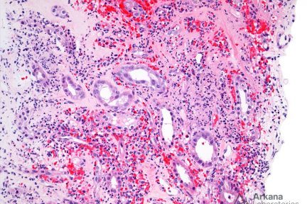 Medullary Angiitis