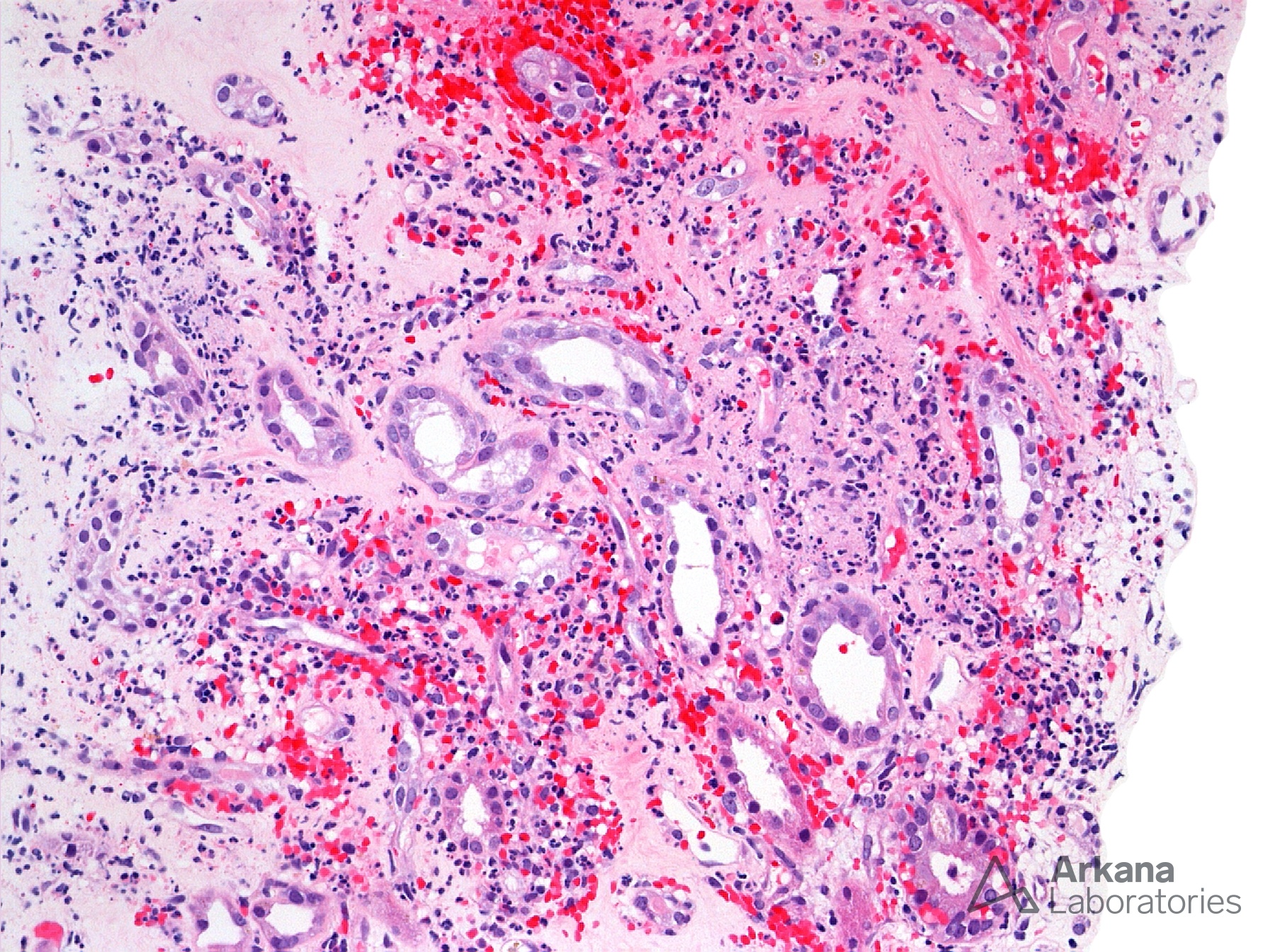 Medullary Angiitis