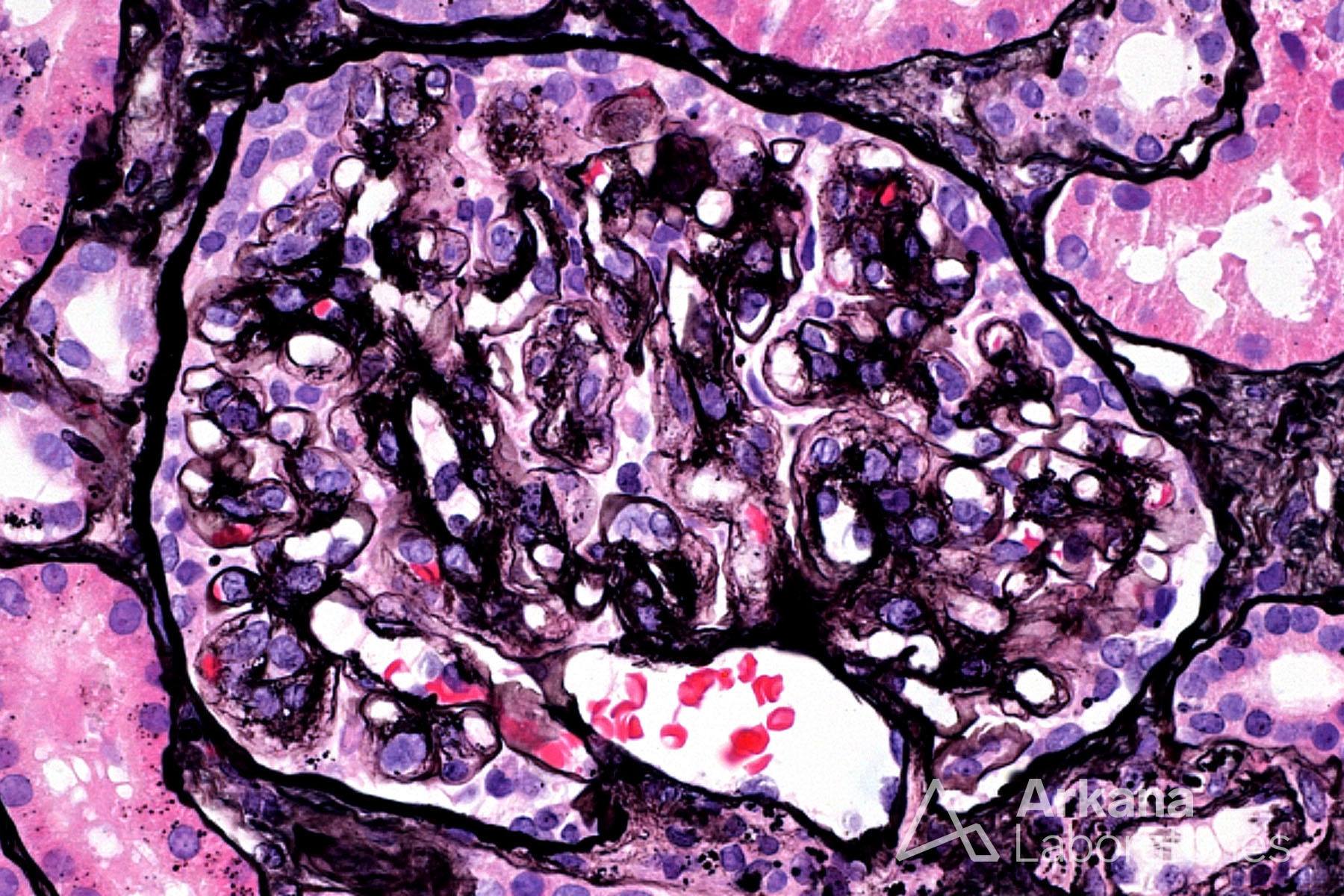 Monoclonal gammopathy of renal significance