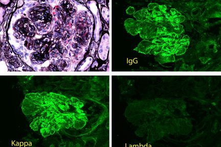 Proliferative Glomerulonephritis with Monoclonal IgG Deposits