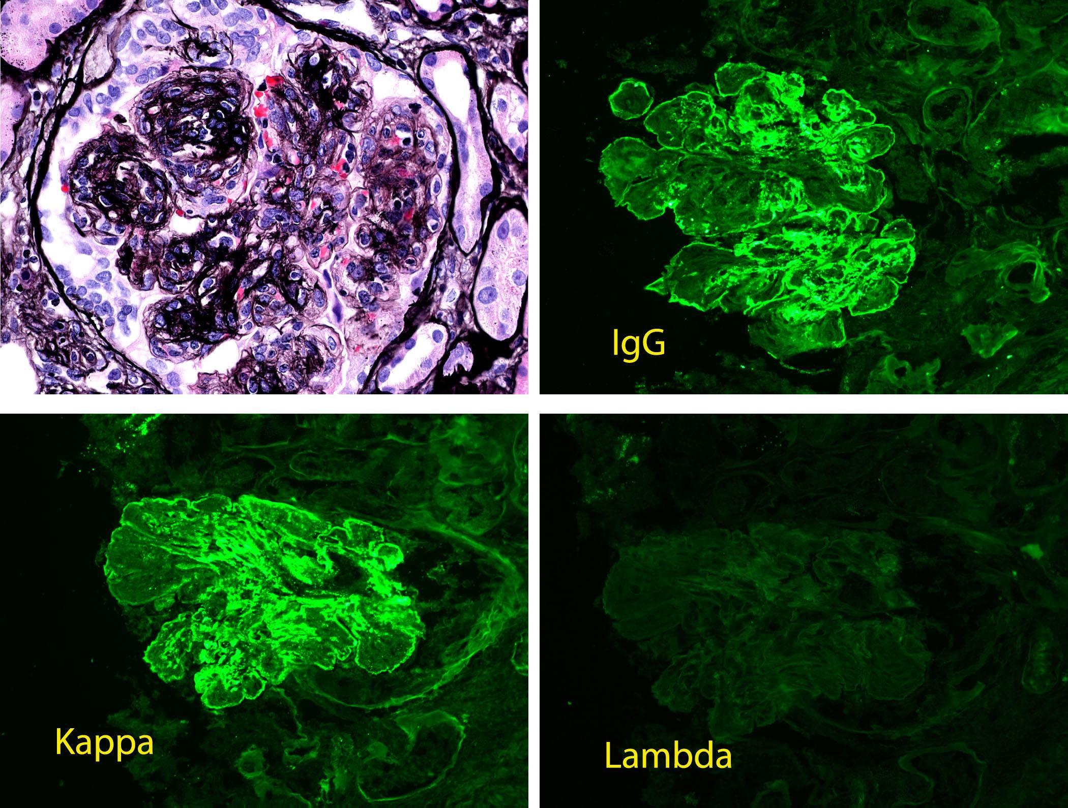Proliferative Glomerulonephritis with Monoclonal IgG Deposits