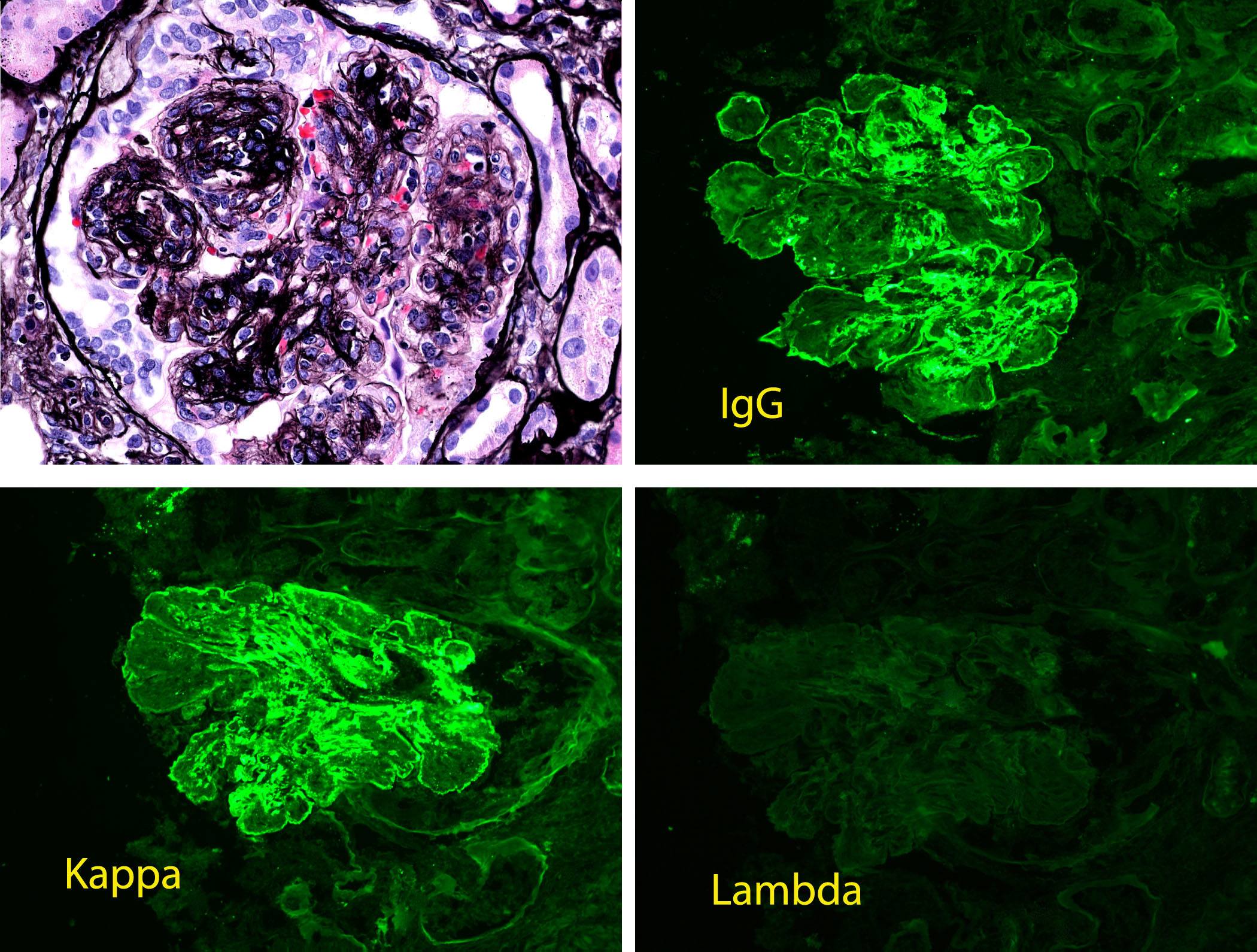 Proliferative Glomerulonephritis with Monoclonal IgG Deposits