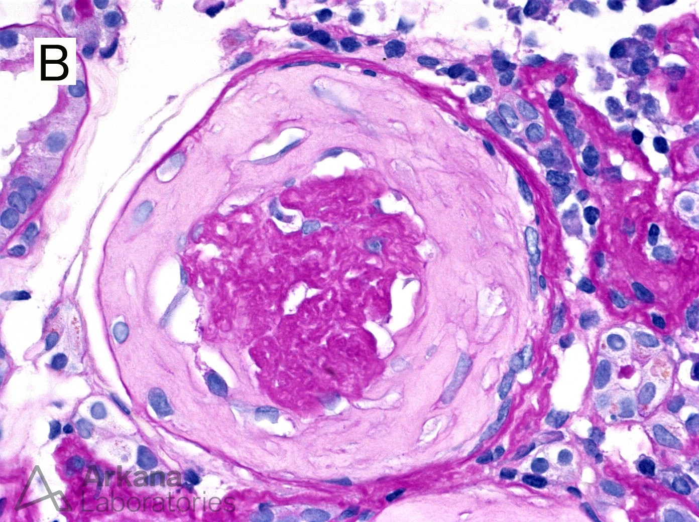 Chronic Lesions of ANCA - Fibrous Crescent