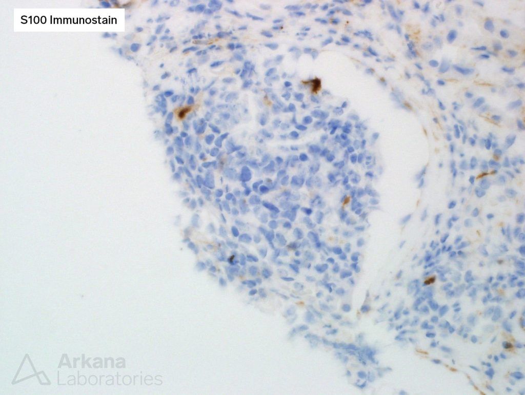 S100 immunostain, tumor cells, arkana laboratories