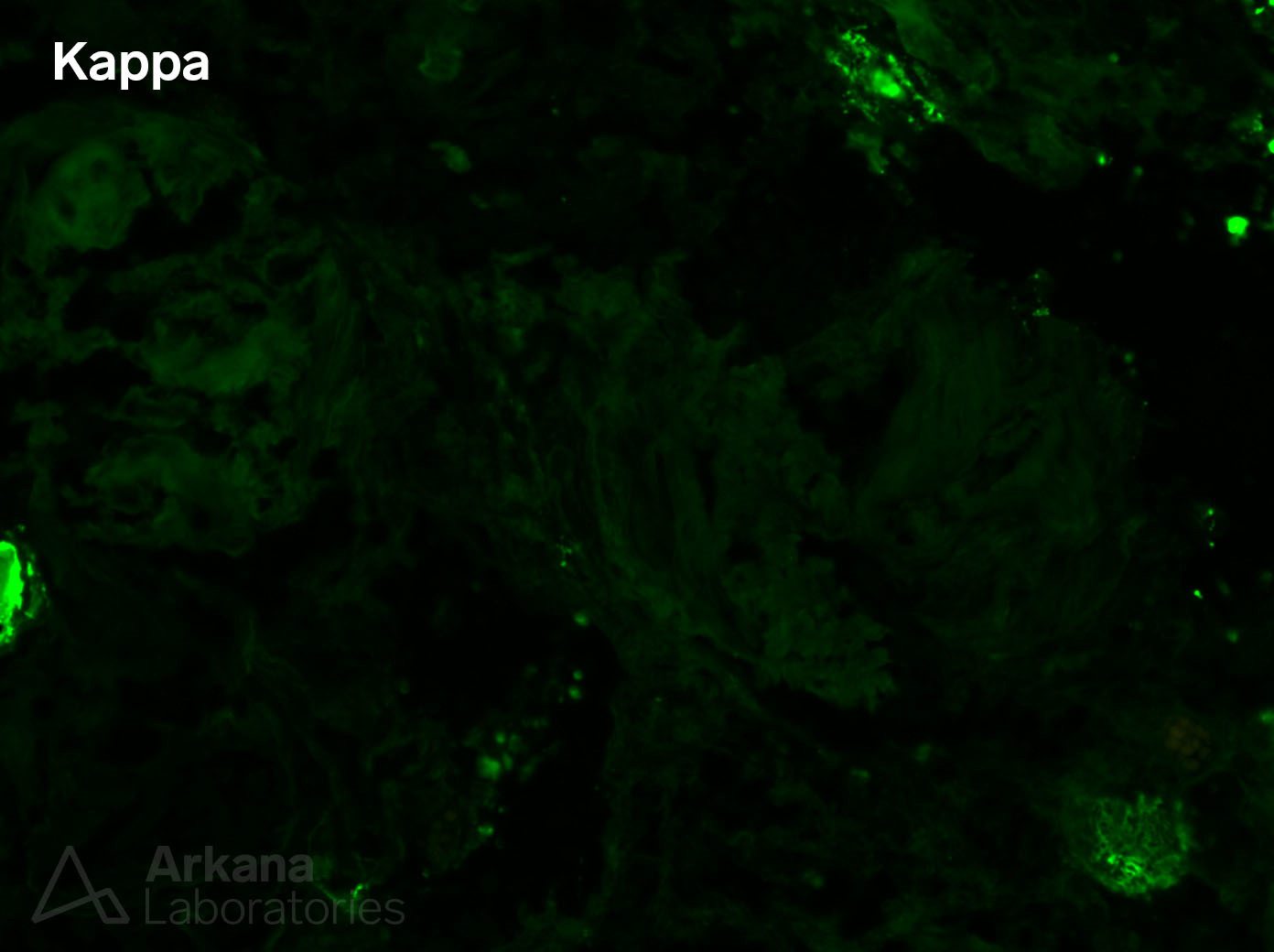 LECT2 Amyloid