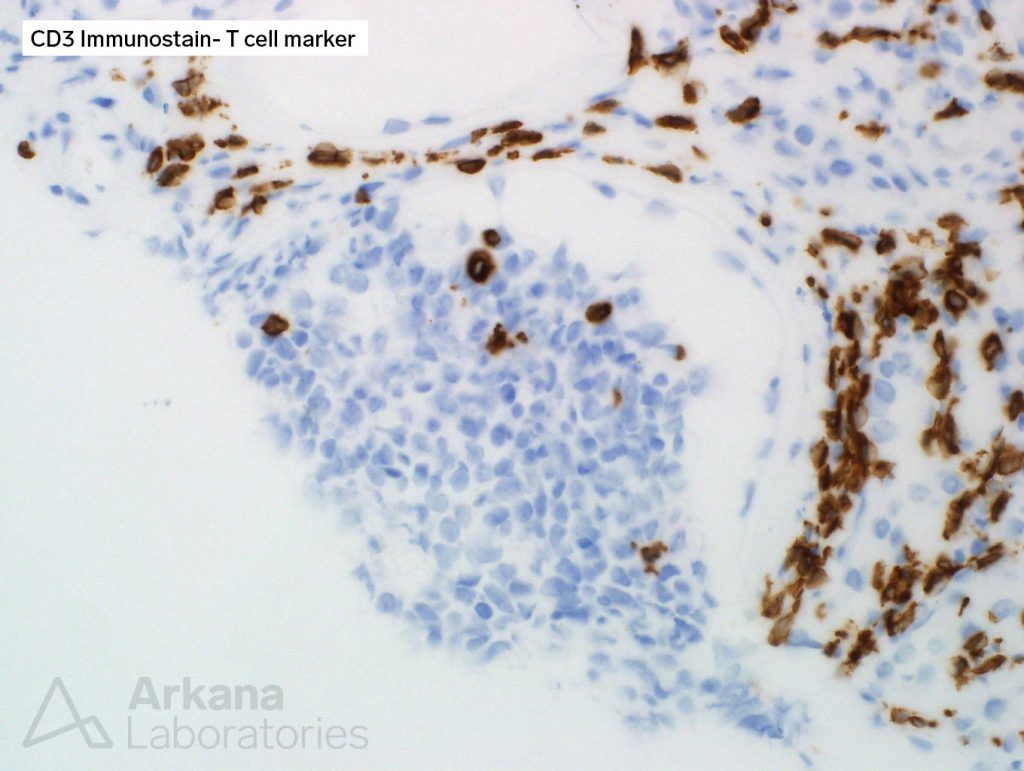 CD3 (T-cell marker) and CD20 (B-cell marker) immunostains, pathology, arkana laboratories