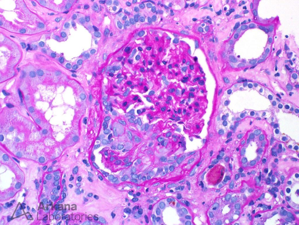 glomerulus with a cellular crescent