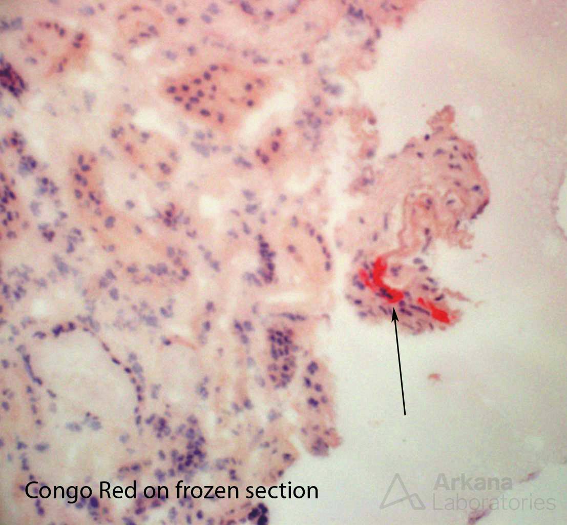 AL amyloidosis