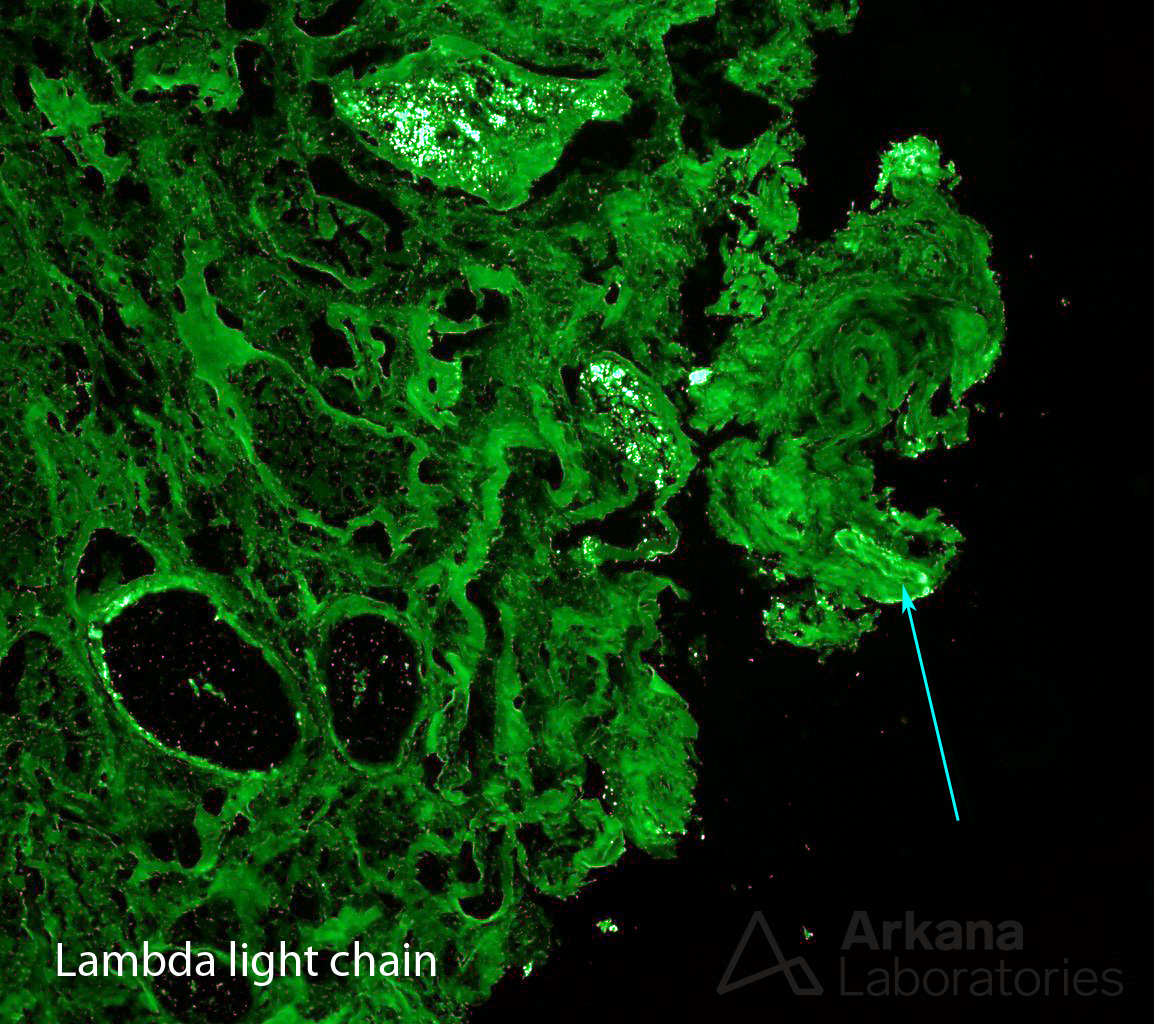 AL amyloidosis