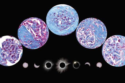 An Eclipse Under the Scope: A Renal Pathologist’s View