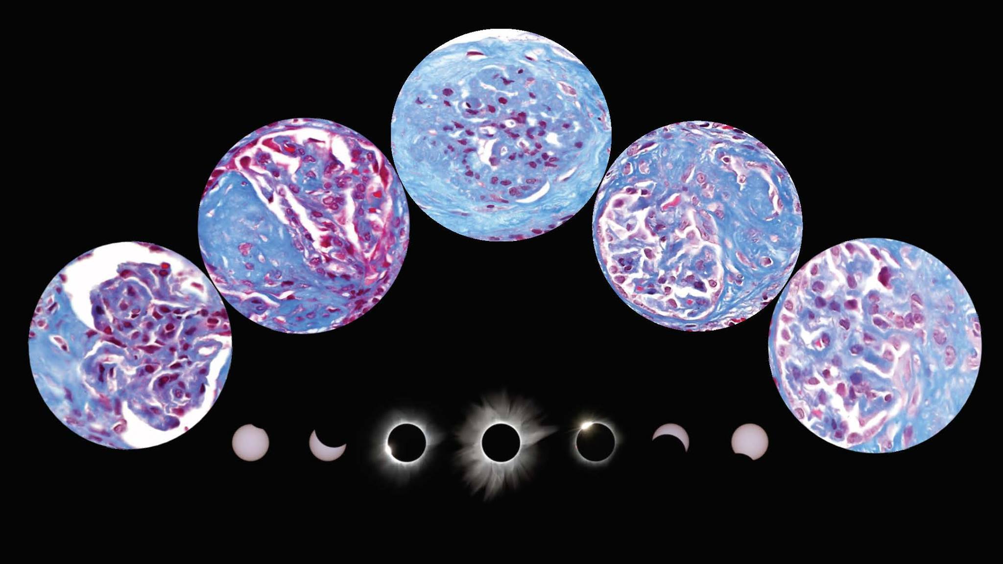 An Eclipse Under the Scope: A Renal Pathologist’s View
