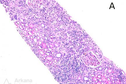 fibrosis, Chronic interstitial nephritis, CIN