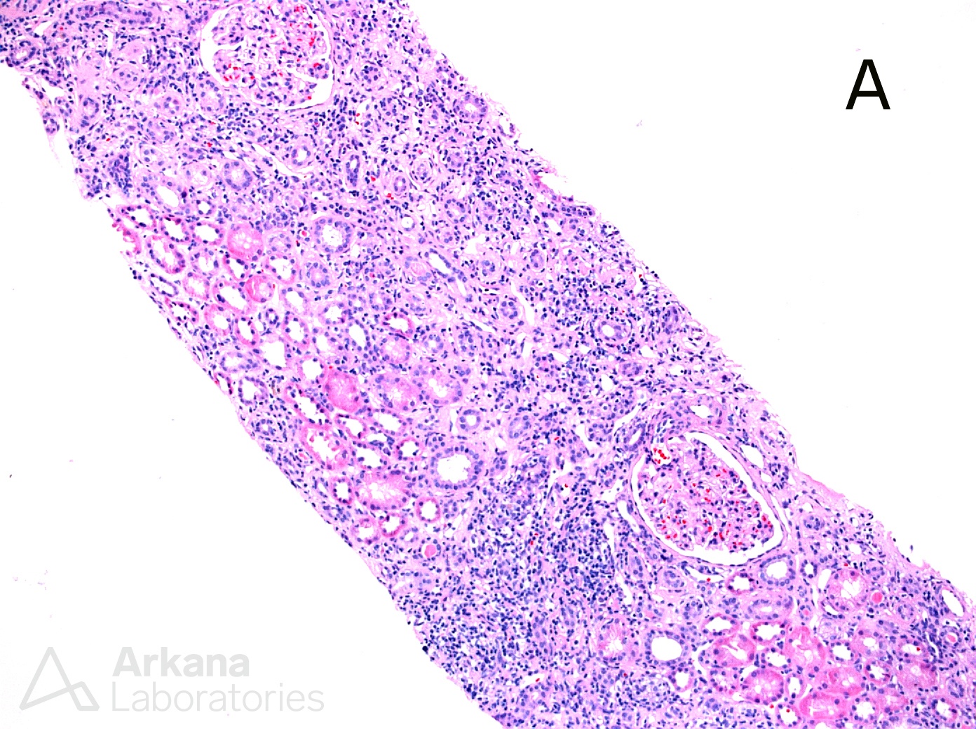 fibrosis, Chronic interstitial nephritis, CIN