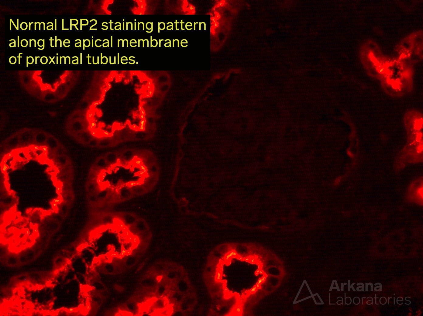 Anti-LPR2 Nephropathy, Anti-Brush Border Antibody Disease