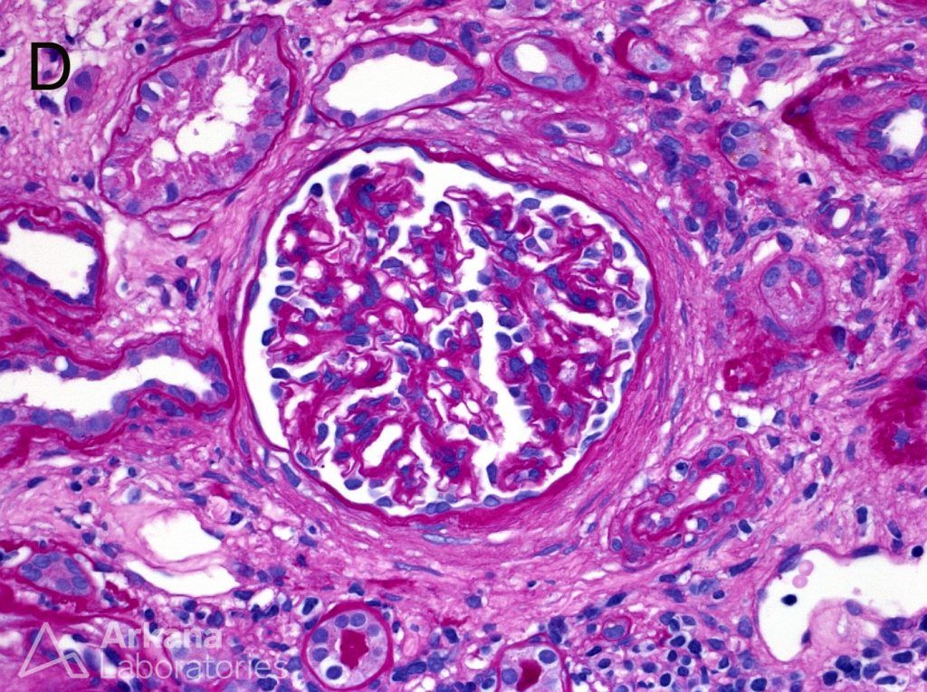 Periglomerular fibrosis with PAS-positive thickening surrounding Bowman’s capsule of an intact glomerulus