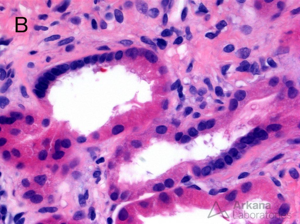 Nephronophthisis, Macula densa-like lesions