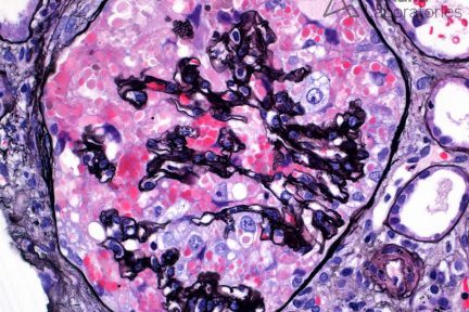 Collapsing Glomerulopathy