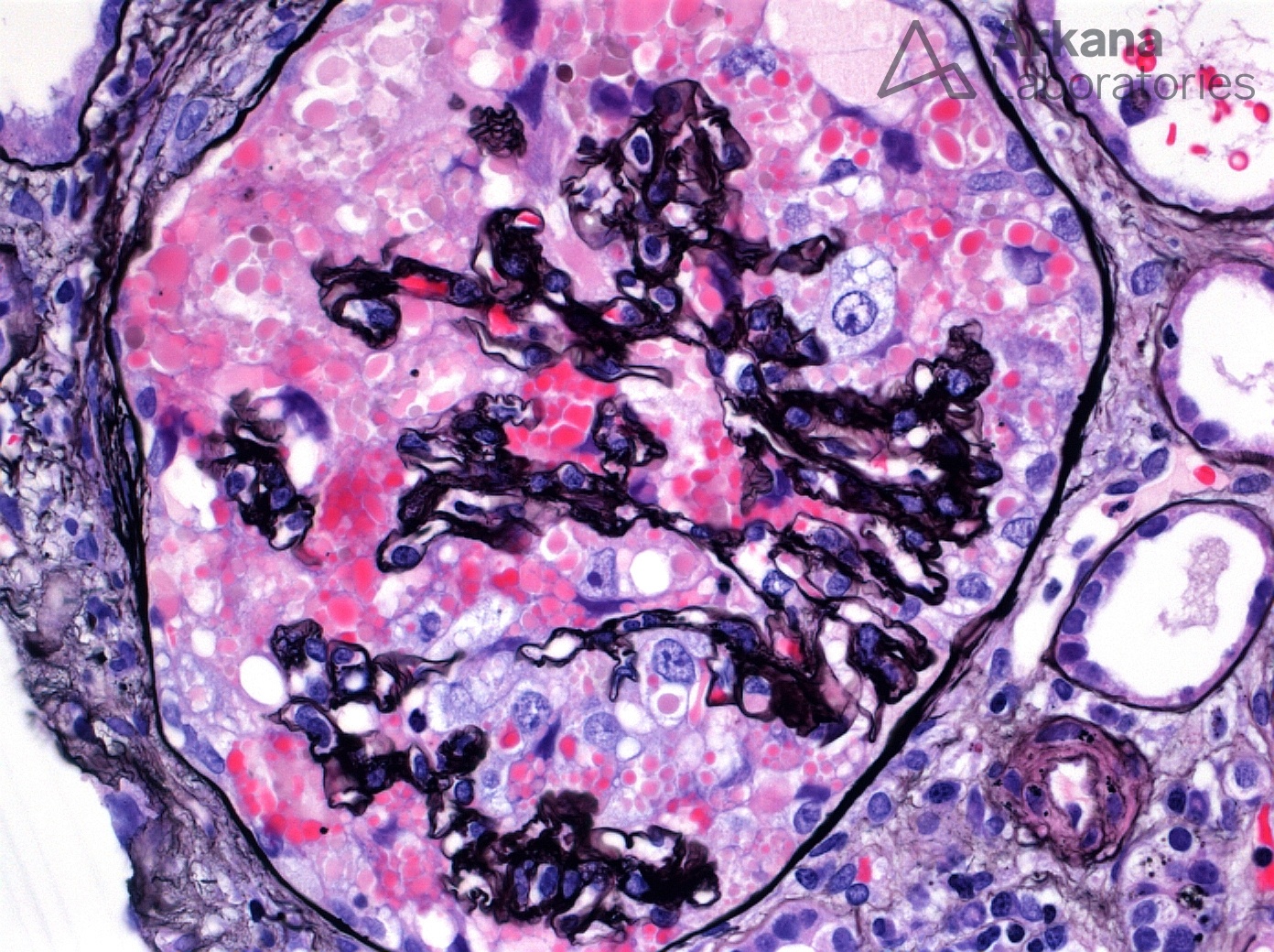 Collapsing Glomerulopathy