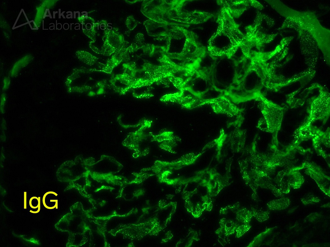 IgG renal biopsy stain, Membranous glomerulopathy