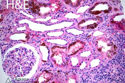 Renal hemosiderosis