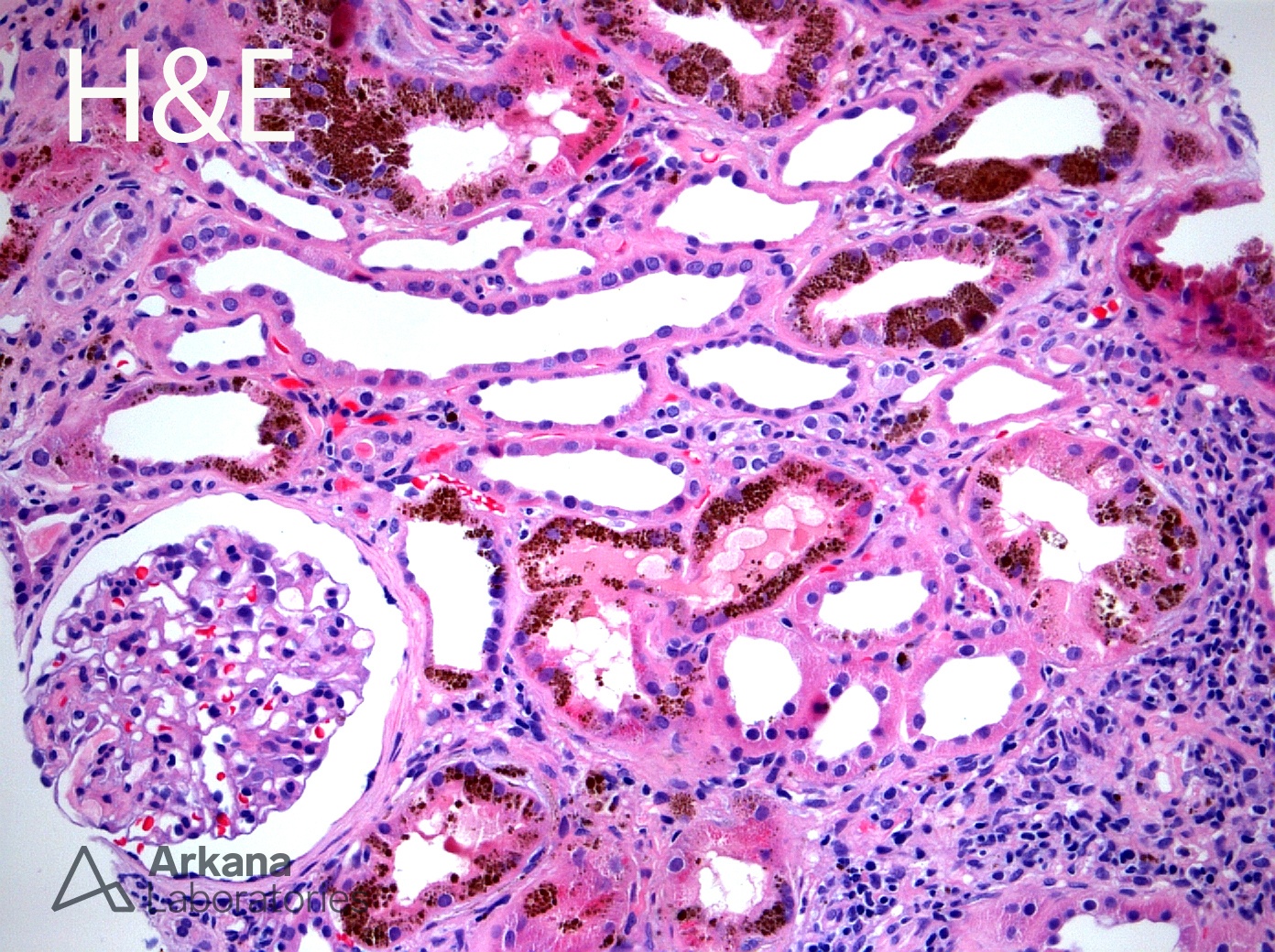 Renal hemosiderosis