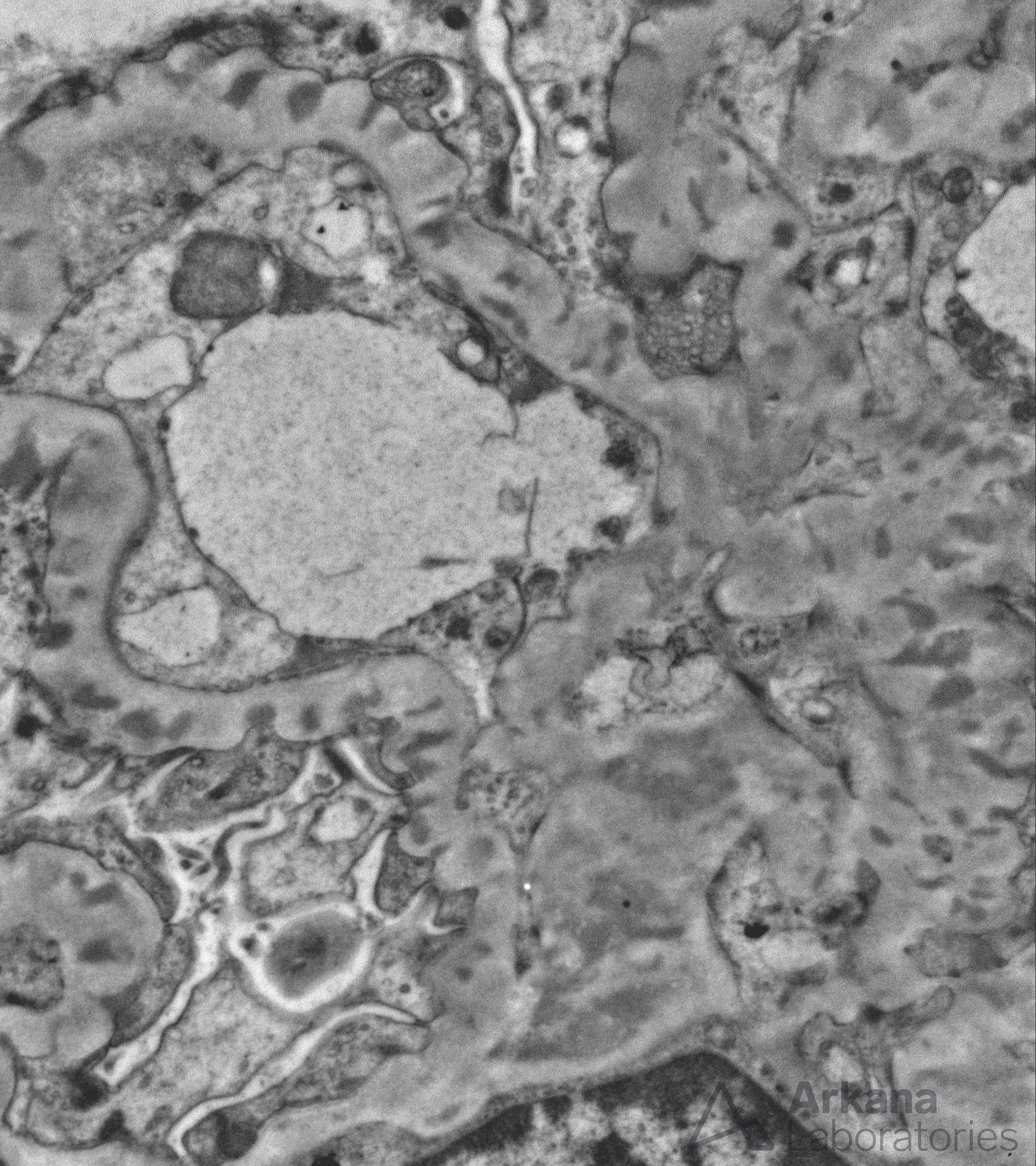 Membranous Lupus Nephritis imaging