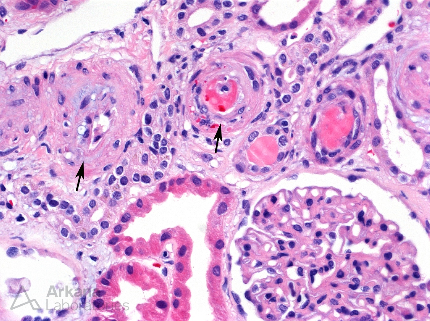 Malignant Hypertension