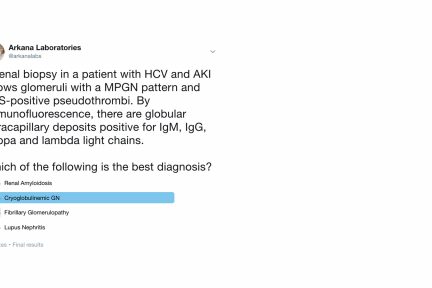 Mixed cryoglobulinemia