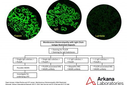 Membranous Glomerulopathy