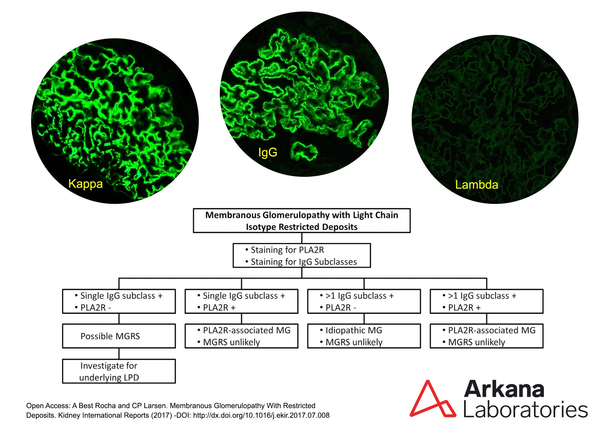 Membranous Glomerulopathy