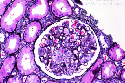 mesangiolysis, renal pathology, kidney biopsy stain, arkana laboratories