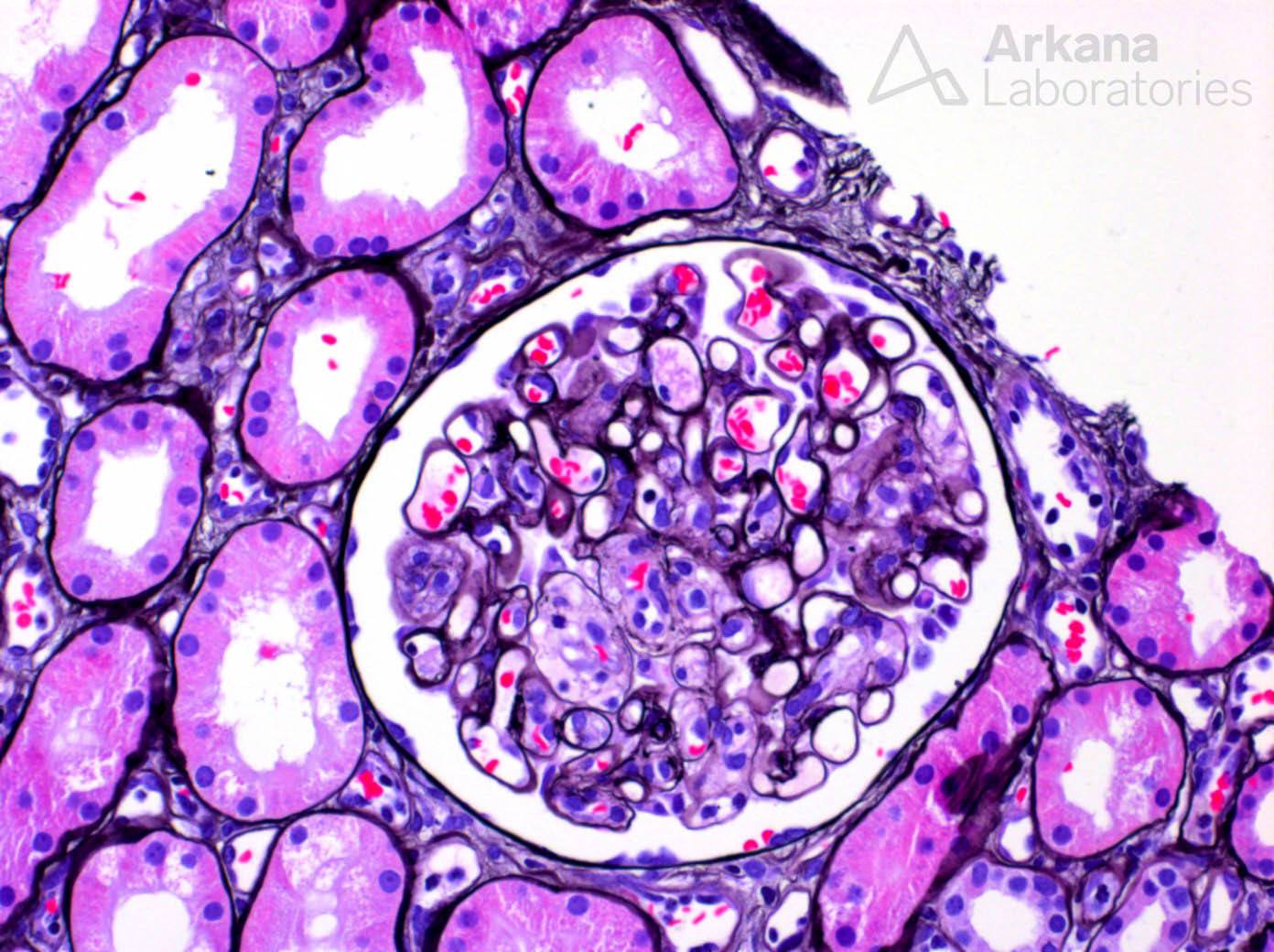 mesangiolysis, renal pathology, kidney biopsy stain, arkana laboratories