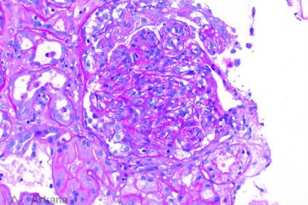 IgA, IgA Dominant Infection-Associated Glomerulonephritis, renal pathology, arkana laboratories, pathology of the kidney