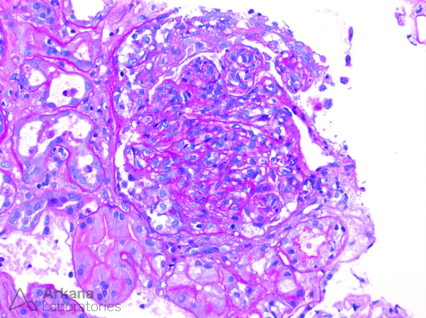 IgA, IgA Dominant Infection-Associated Glomerulonephritis, renal pathology, arkana laboratories, pathology of the kidney