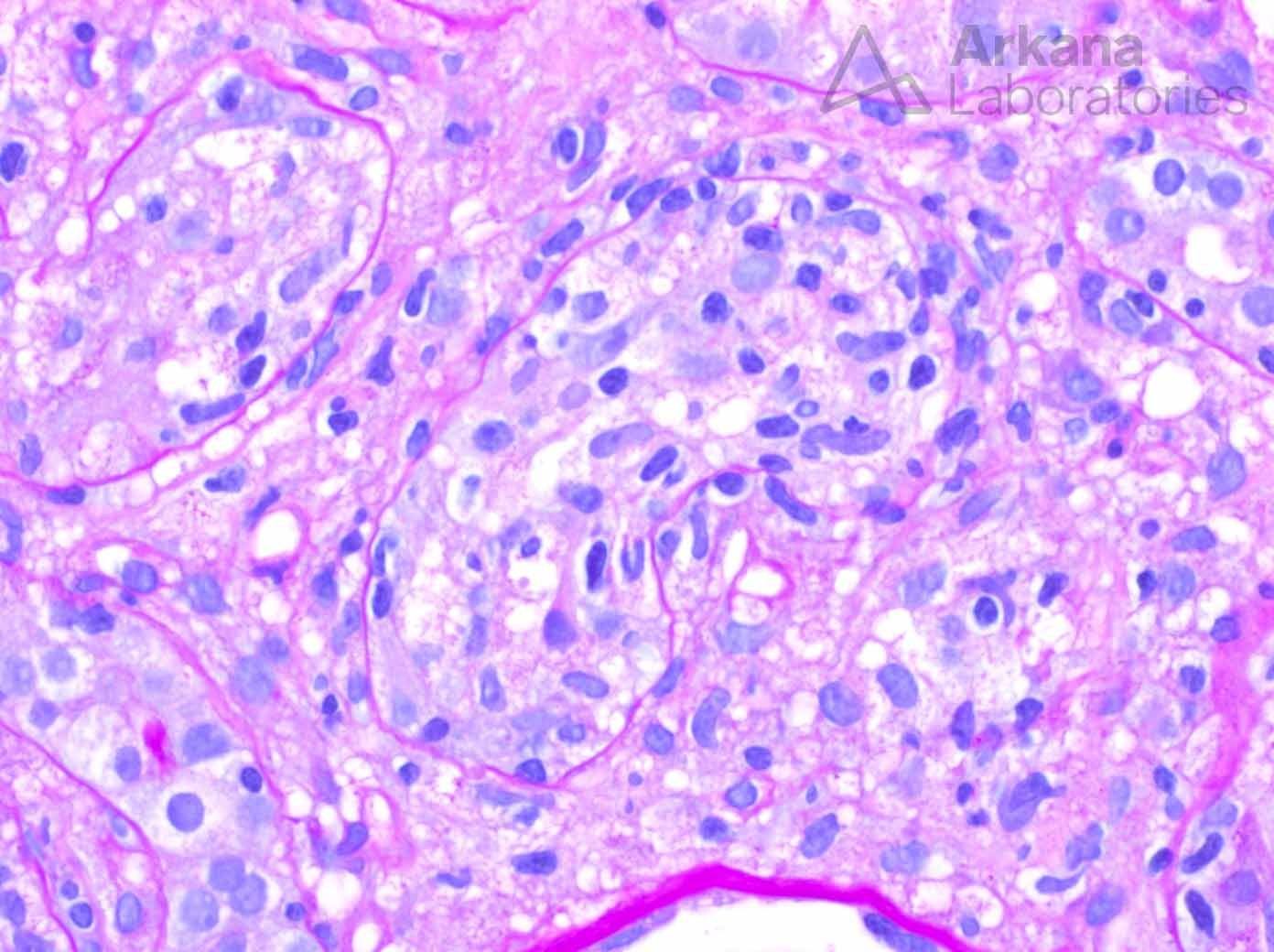 Acute Interstitial Nephritis