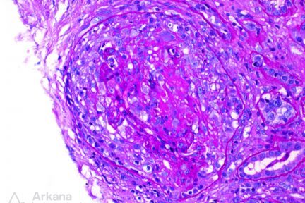 ANCA-mediated disease