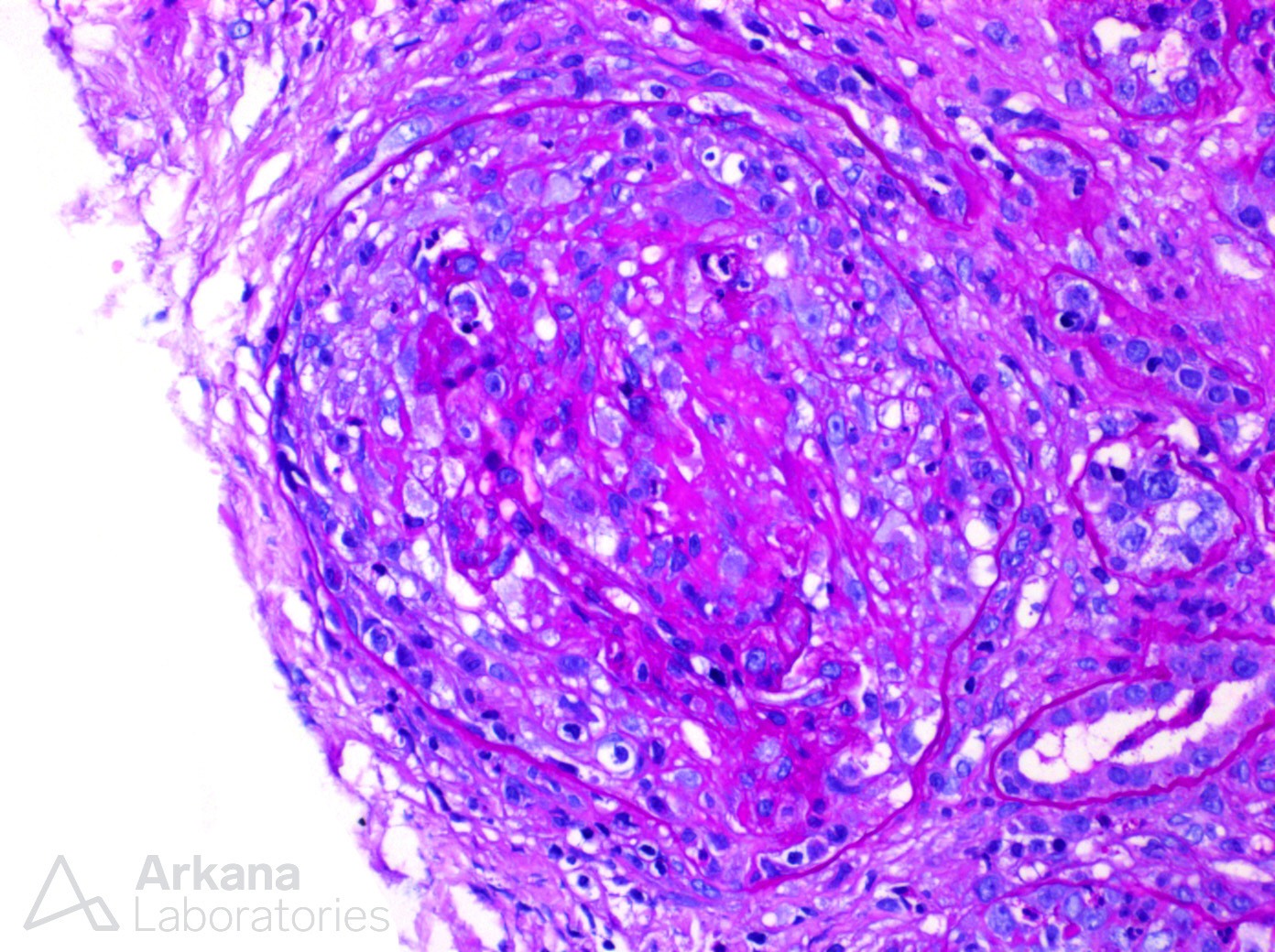 ANCA-mediated disease