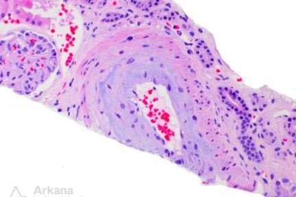Scleroderma in a renal biopsy at Arkana Laboratories