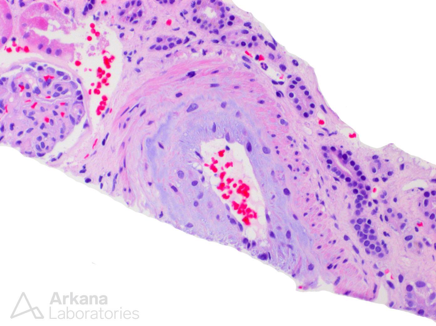 Scleroderma in a renal biopsy at Arkana Laboratories